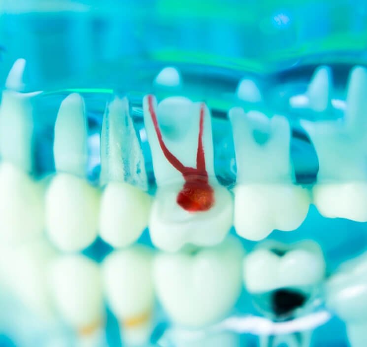 Symptoms for root canal