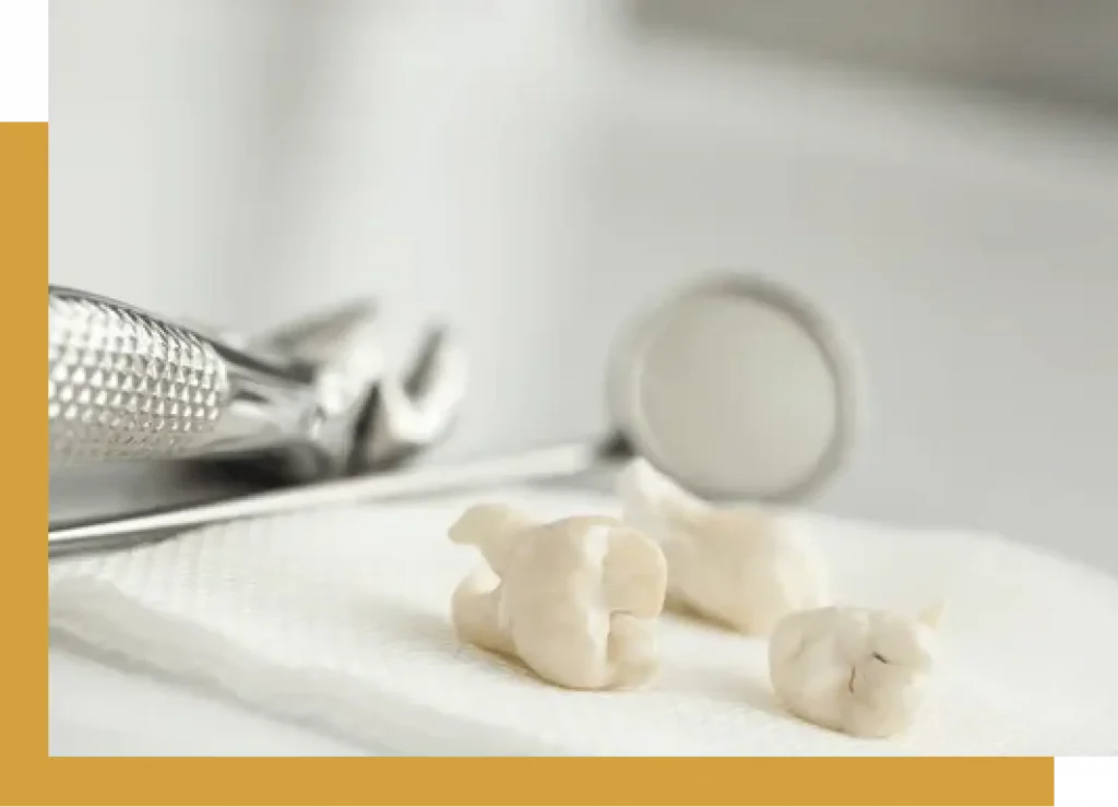 tooth extraction