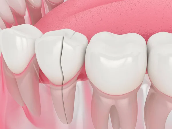 Cracked tooth