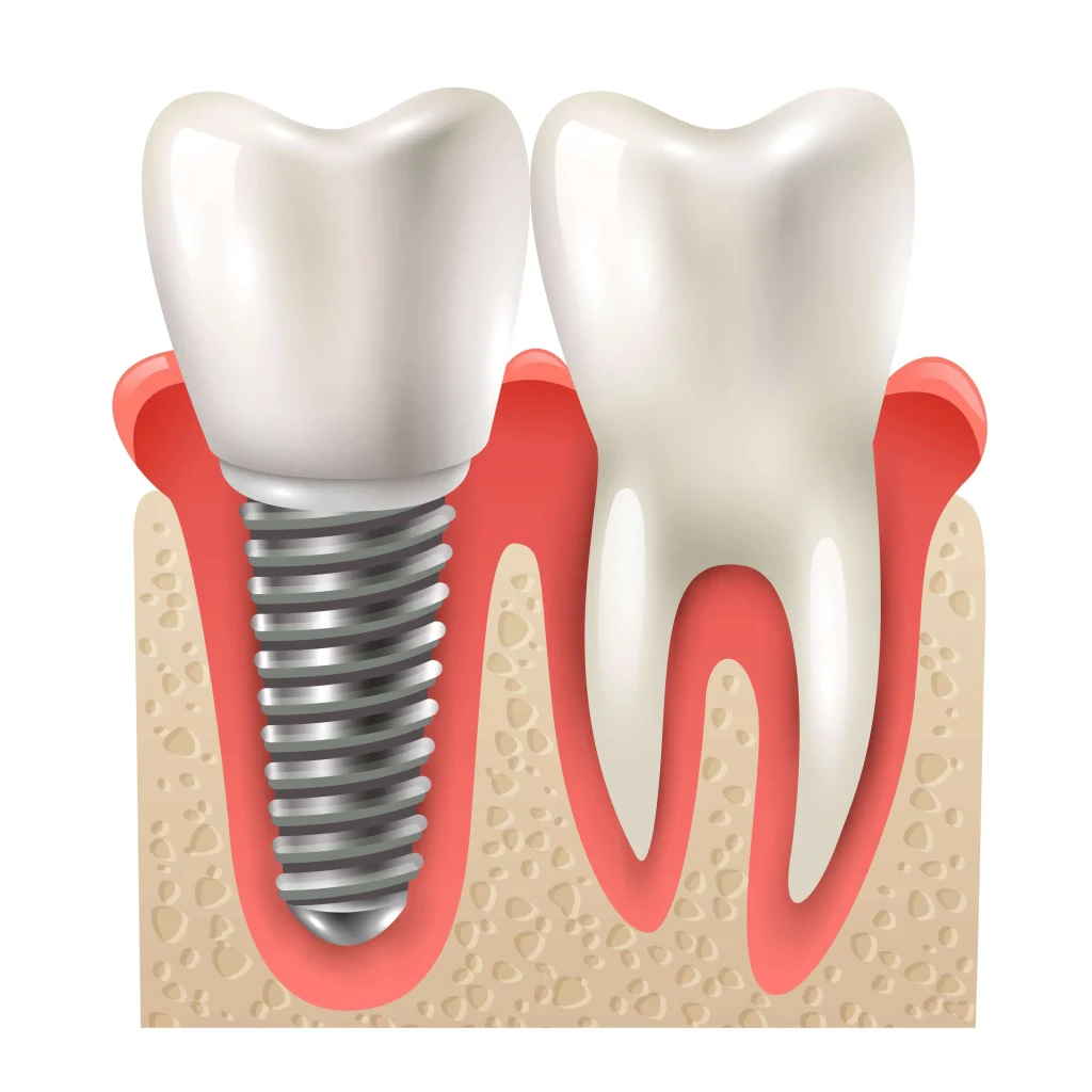 Dental Implants Round Rock, TX