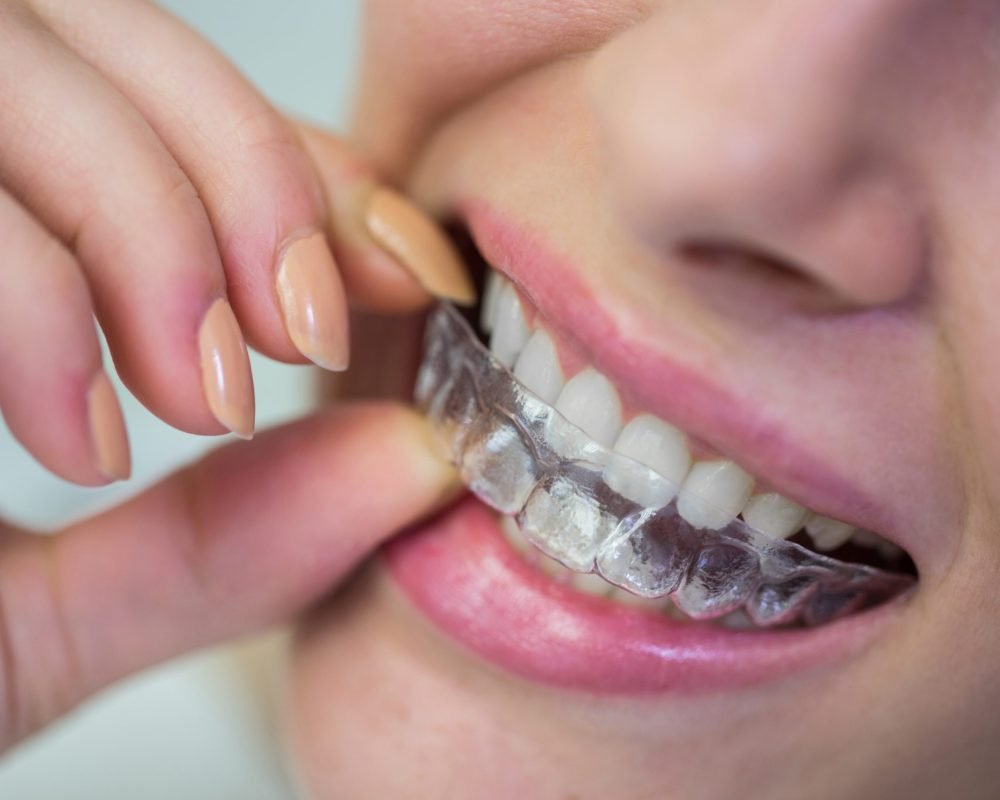 Close-up of woman wearing orthodontic silicone invisible braces Close-up of woman wearing orthodontic silicone invisible braces